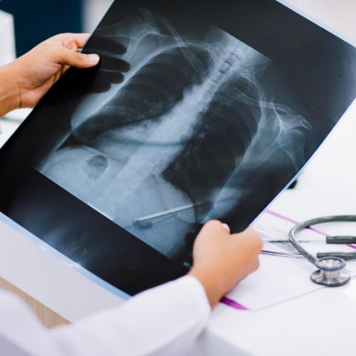 X RAY CHEST PA